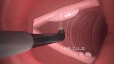 Laryngeal Lesion Removal (3D Animation) Vocal Cord Repair Surgery