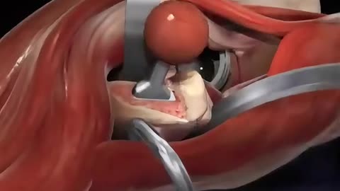 Hip Replacement Surgery (3D Animation)