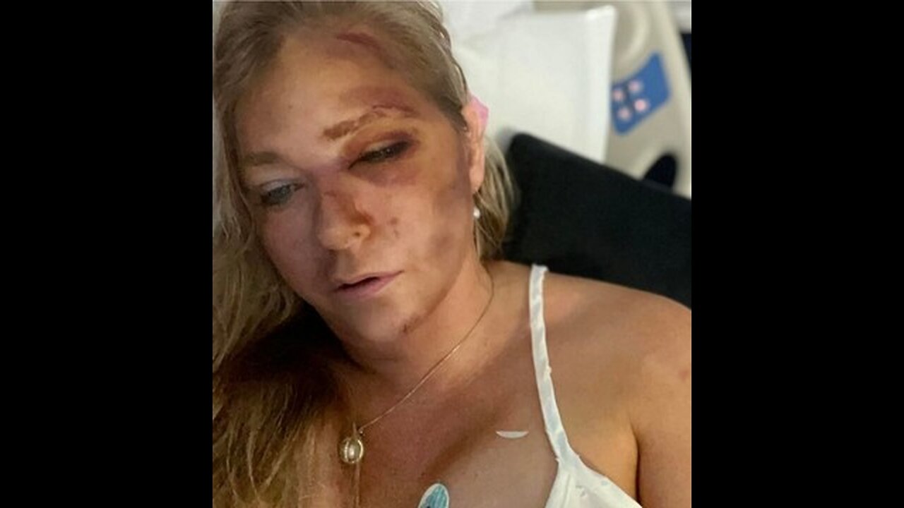 High Profile Epstein Victim To Die Within Days Under Mysterious Circumstances, Appears Badly Beaten