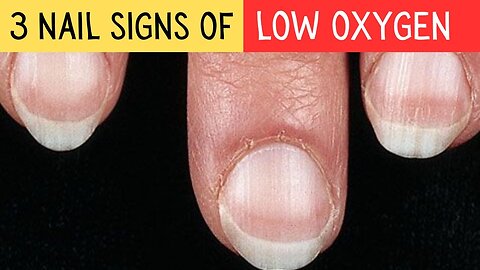 3 Nail Signs Of Low Oxygen In The Body! MD21