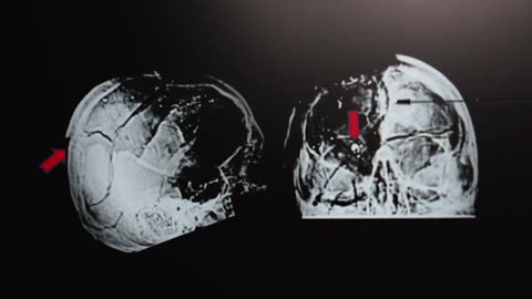 Mantik Findings: extant NARA X-Rays are FORGERIES-HSCA Tampered Further-Bullet inserted-White Patch