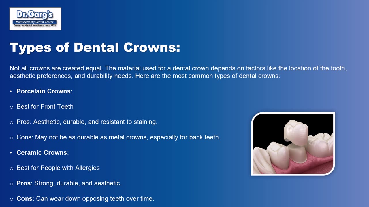 Everything You Need to Know About Dental Crowns and How They Can Transform Your Smile