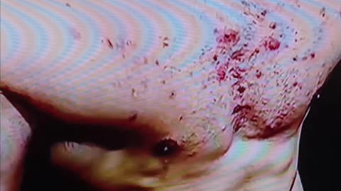 Steroid acne?