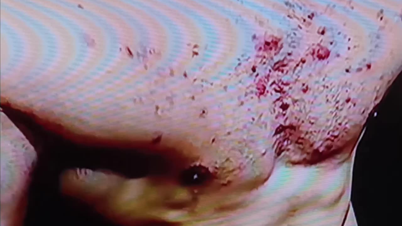 Steroid acne?