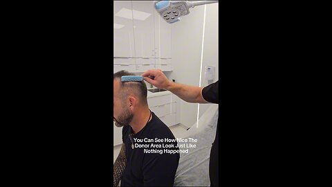 Incredible results after 4 1/2 months ! #hairtransformation #naturalresults #hairtransplant