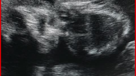 KGMU ‘Love Jihad’: Resident Doctor Accused of Sexual Exploitation, Forced Conversion, Blackmail