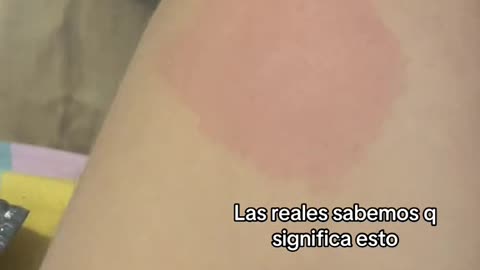 Todos: Dermografismo Yo: 1 hora en el baño