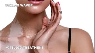 Vitiligo Treatment +33X