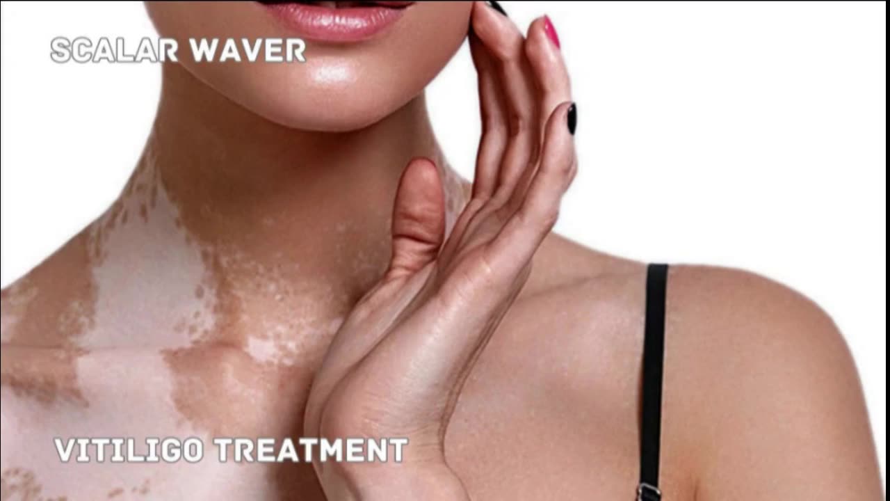 Vitiligo Treatment +33X