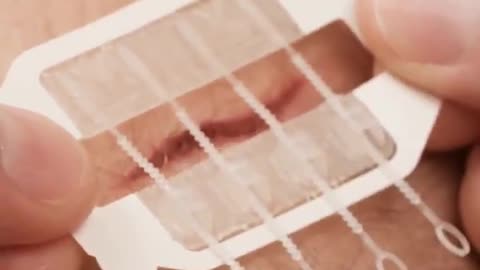 This device stitches you up without the need of stitches