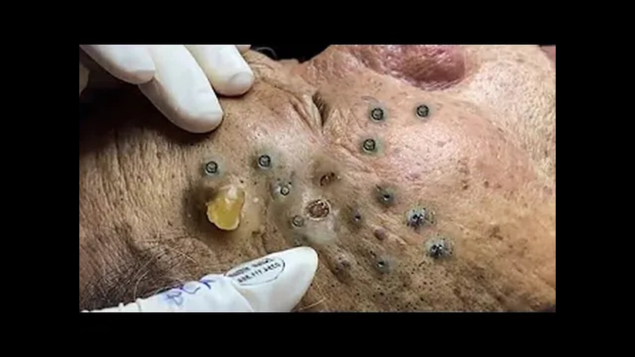 Relaxing Big Blackheads & Milia, Whiteheads Removal Pimple Poppings