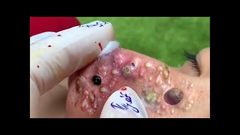 Blackheads Removal & Pimple Popper Cystic Acne Extraction 2