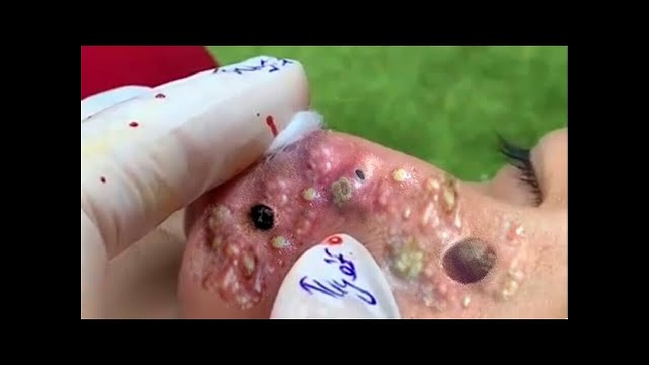 Blackheads Removal & Pimple Popper Cystic Acne Extraction 2