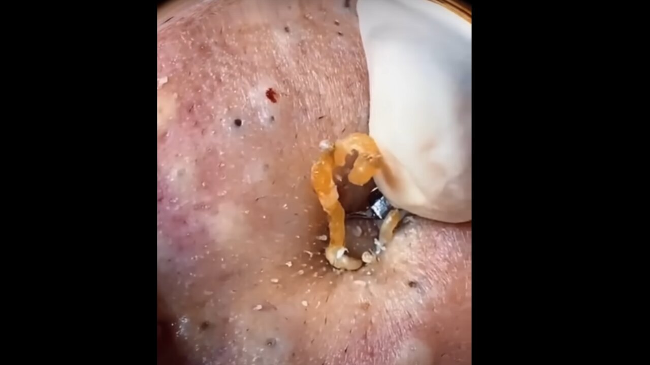 The Best TIKTOK PIMPLES
