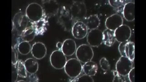 Live Blood Analysis - Bacteria forming in red blood cells as seen in dark field microscopy