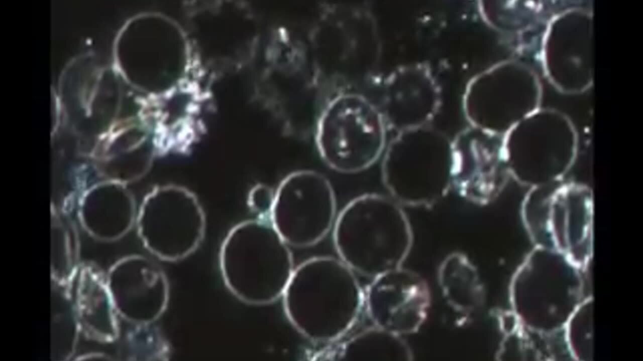 Live Blood Analysis - Bacteria forming in red blood cells as seen in dark field microscopy