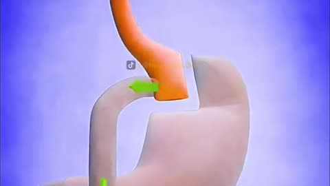 Gastric Bypass Surgery (3D Animation)