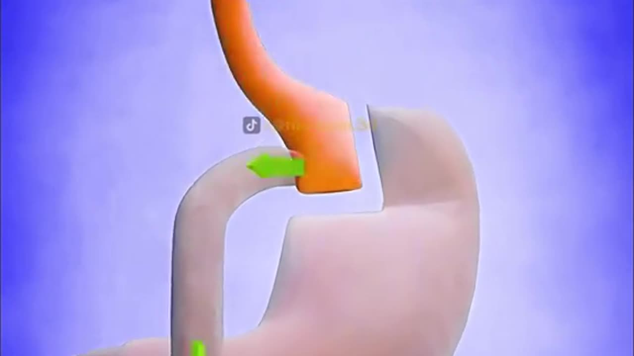 Gastric Bypass Surgery (3D Animation)