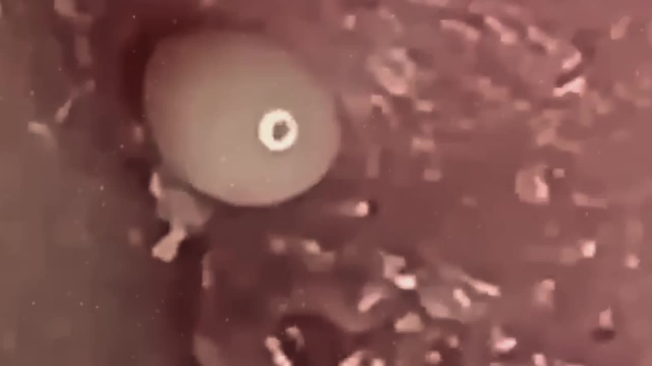 Blackhead removal new this week (ASMR) #1 #shorts