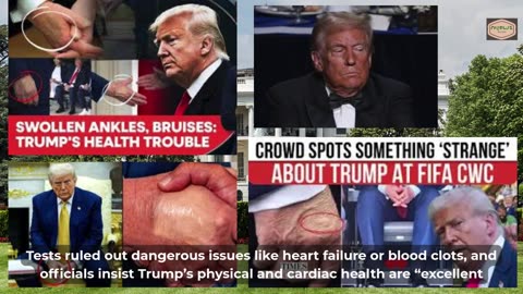 From Swollen Legs to Bruised Hands—Inside Trump’s Health Secrets