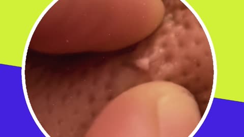 Pimple removal satisfying video (ASMR) #15 #shorts