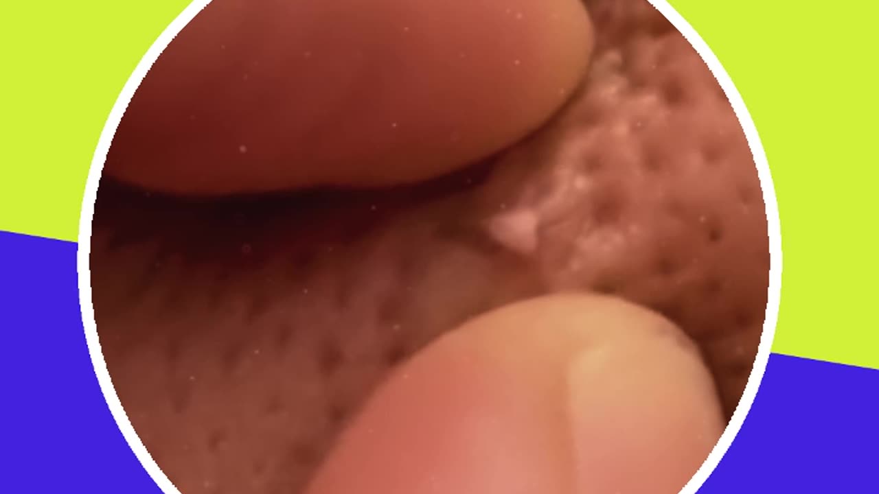 Pimple removal satisfying video (ASMR) #15 #shorts