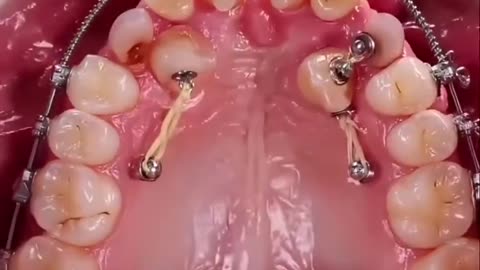 Visualisation of how braces align teeth