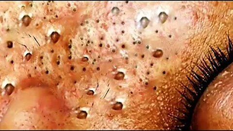 Blackheads & Whiteheads Satisfying Removal