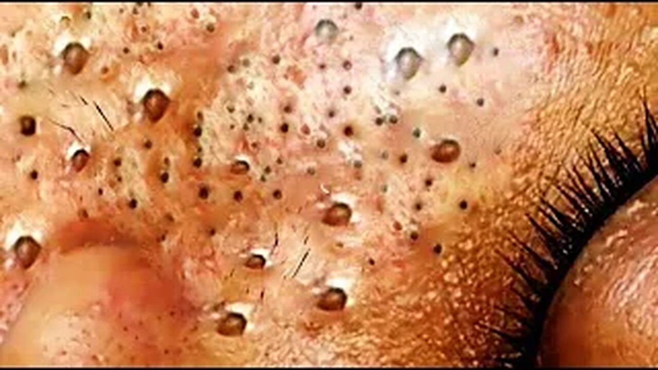 Blackheads & Whiteheads Satisfying Removal