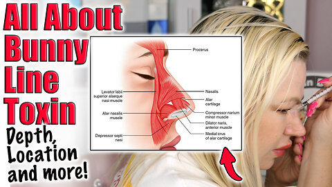 All about Bunny Botox, aka Nose Toxin! Code Jessica10 Saves you Money, Wannabe Beauty Guru