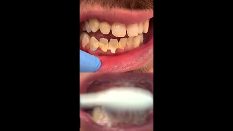 NATURAL RECIPE TO WHITTEN YOUR TEETH