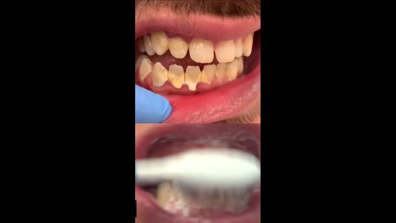 NATURAL RECIPE TO WHITTEN YOUR TEETH