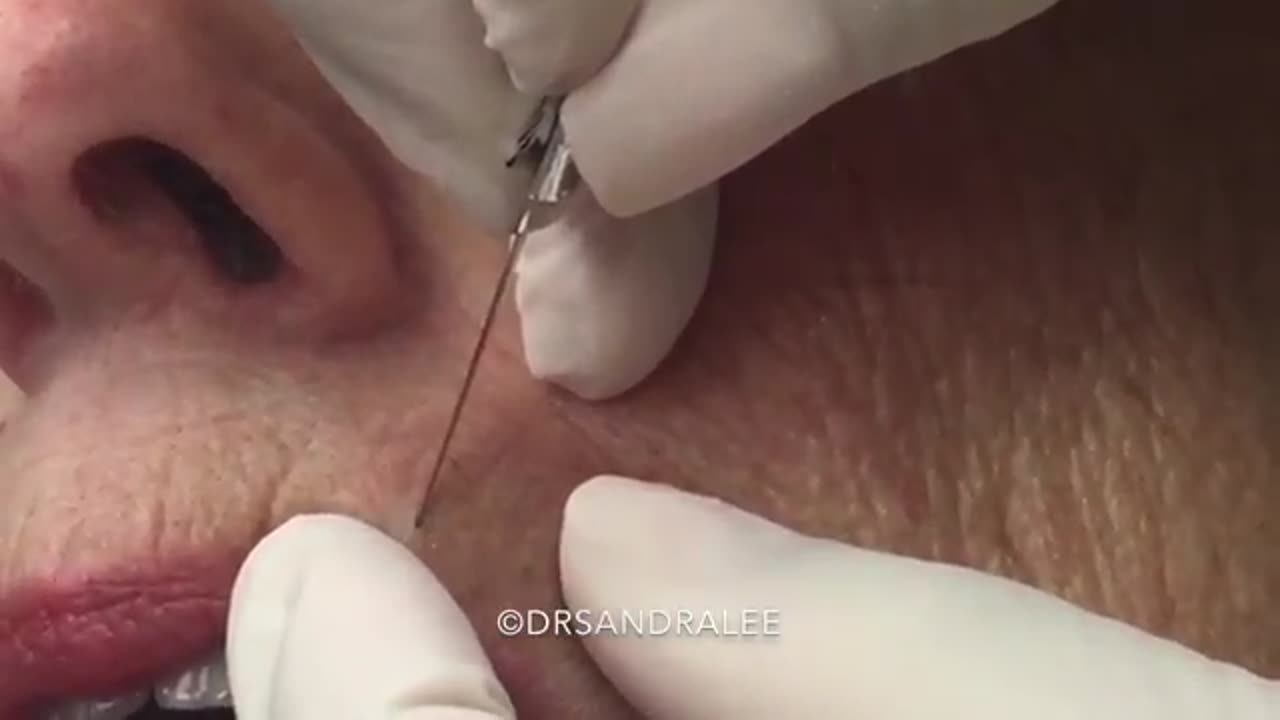 Just two nice blackhead extractions For medical education NSFE