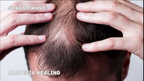 Alopecia Healing +33X