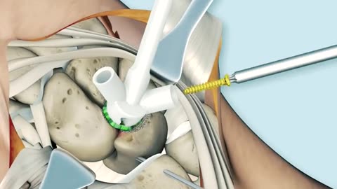 Corner Fusion Surgery Restoring Wrist Stability!