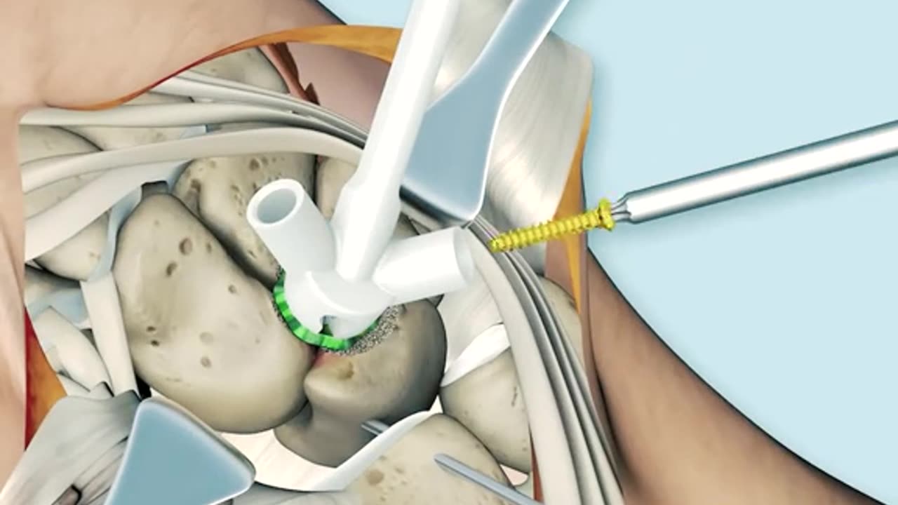 Corner Fusion Surgery Restoring Wrist Stability!