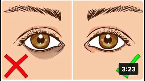 "Eliminating Dark Circles Under Your Eyes: A Guide"