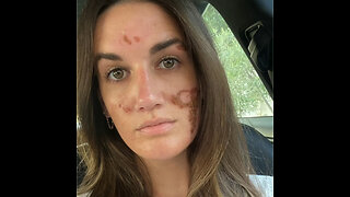 Mujer acusa a esteticista de celebridades de daños permanentes