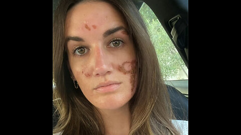 Mujer acusa a esteticista de celebridades de daños permanentes
