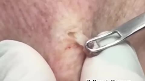 WHAT is this on the arm Extractions with Dr Pimple Popper shorts dpow