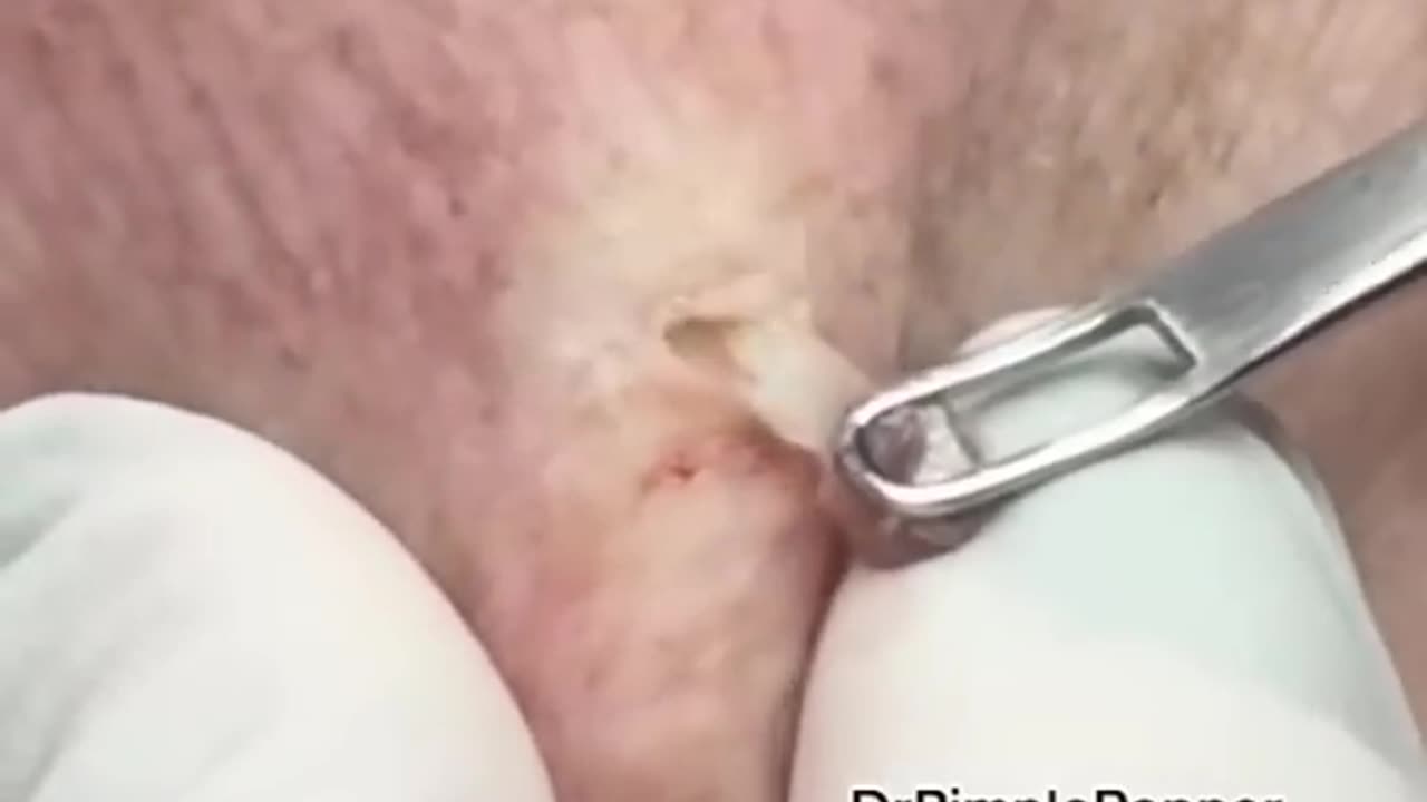 WHAT is this on the arm Extractions with Dr Pimple Popper shorts dpow