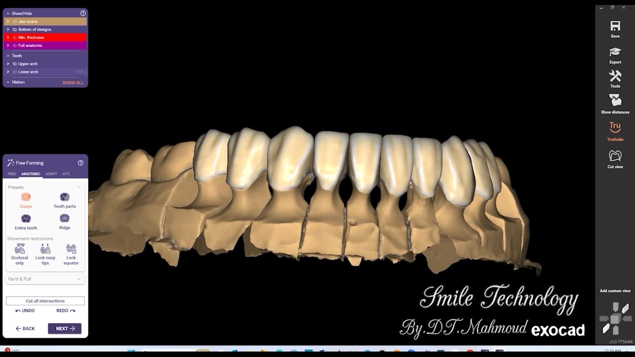 #design #naildesign #dental #dentaldesign #exocadexpert