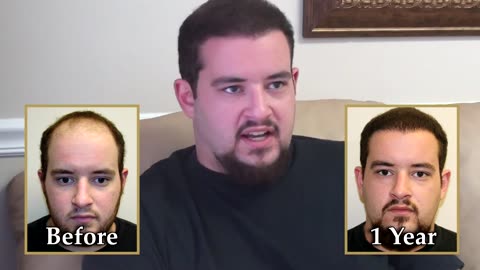 Dr. Brett Bolton Outrageous Hair Transplant Surgery Result
