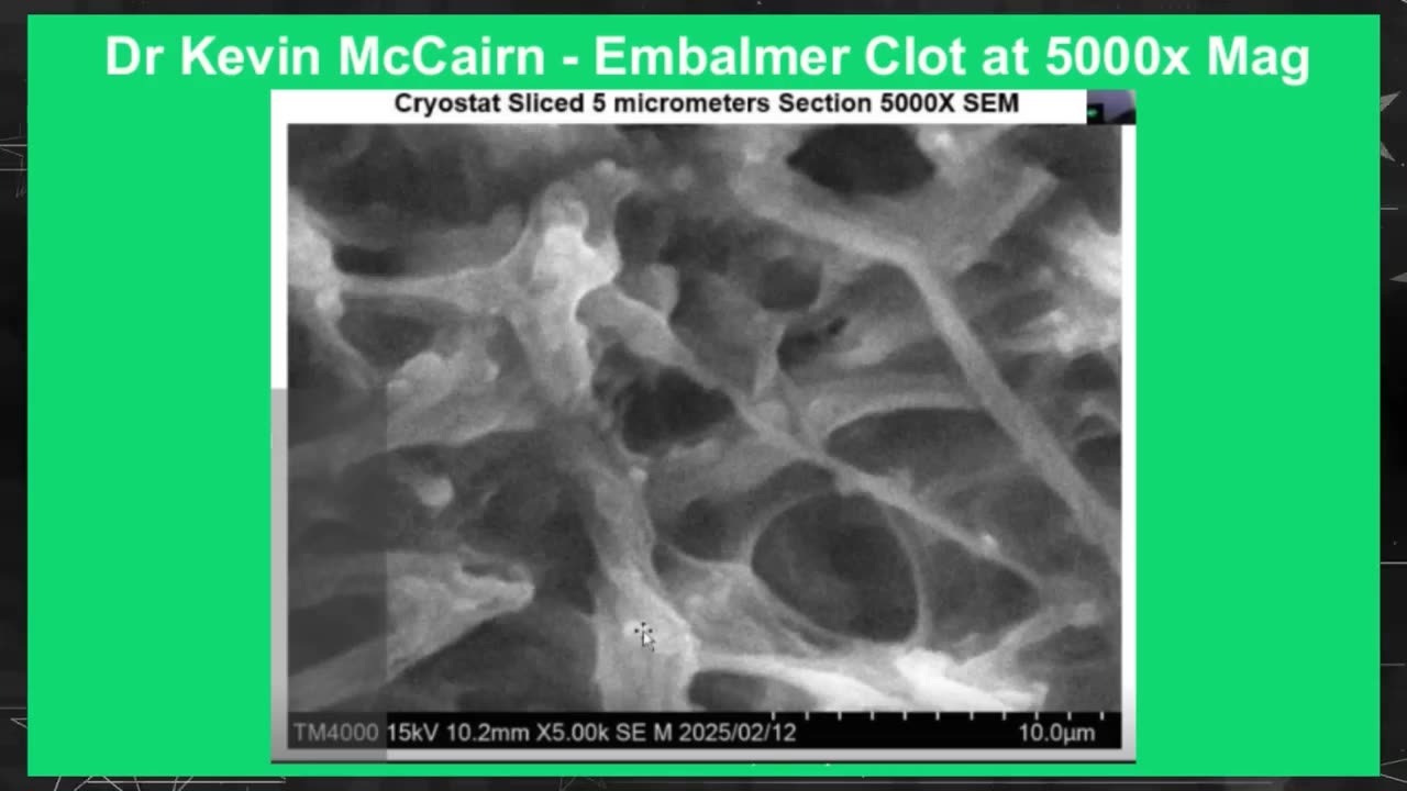 SHOCK! EMBALMERS FINDING WHITE FIBEROUS CLOTS IN BODIES "We've NEVER seen these before" | Redacted