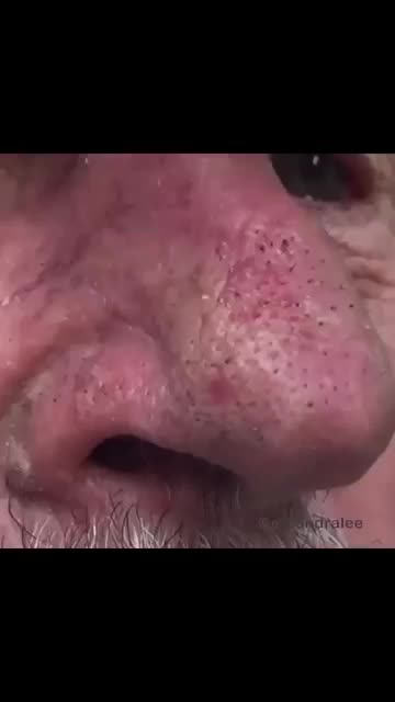 Blackhead Breakfast Special