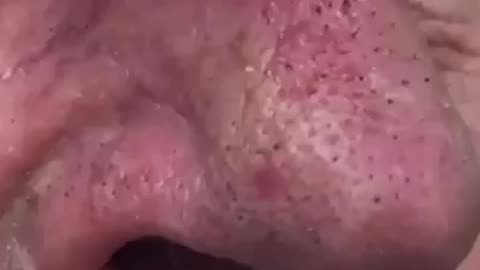 Blackhead Breakfast Special