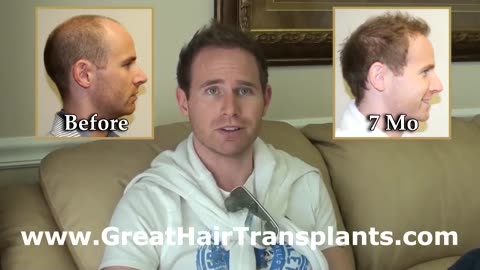 Amazing Hair Transplant Outcome for an International Patient by Dr. Brett Bolton
