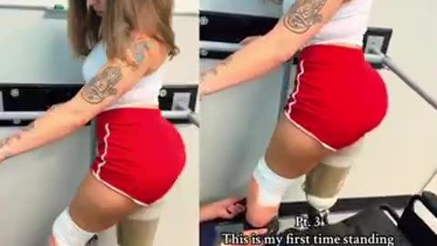 A woman tries her prosthetic legs for the first time, finally giving her the chance to walk again