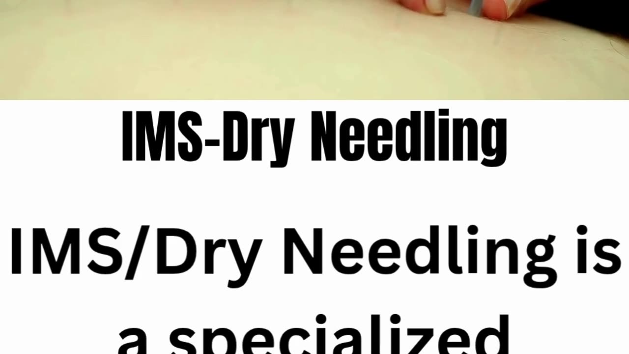 Relieve Muscle Pain Naturally | IMS / Dry Needling in Maple Ridge