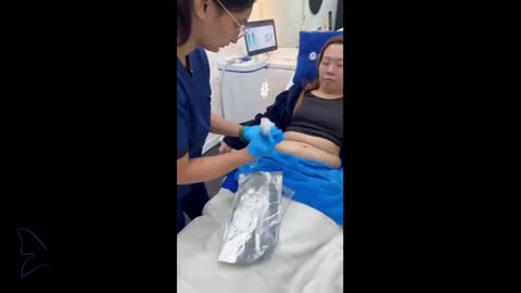 Coolsculpting Elite Applicators For Contoured Body